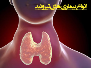 انواع تیروئید
