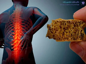 پوکی استخوان چیست