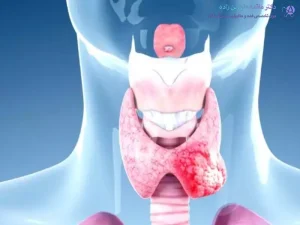 انواع مختلف سرطان تیروئید