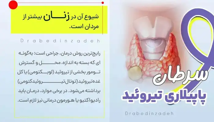 شیوع سرطان پاپیلاری تیروئید