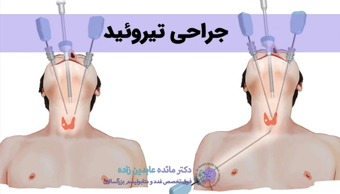 جراحی تیروئید یا تیروئیدکتومی