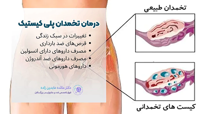 روش های درمان تخمدان پلی کیستیک